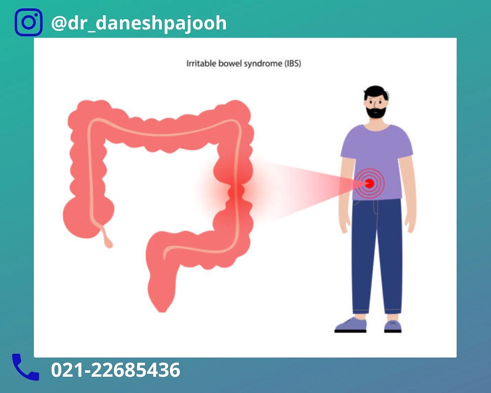 علت سندروم روده تحریک پذیر