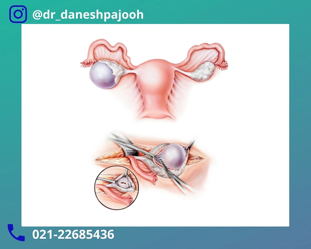 تشخیص کیست درموئید تخمدان در بارداری