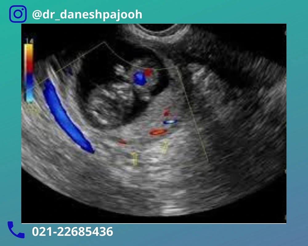 تاثیر کیست درموئید تخمدان در بارداری بر جنین