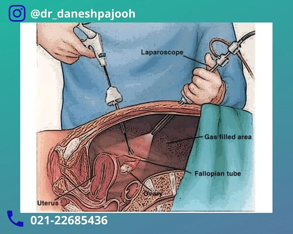 عوارض لاپاراسکوپی