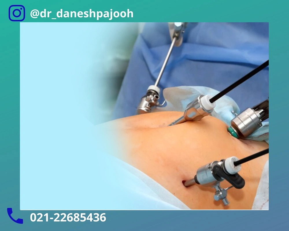 نتیجه گیری لاپاراسکوپی