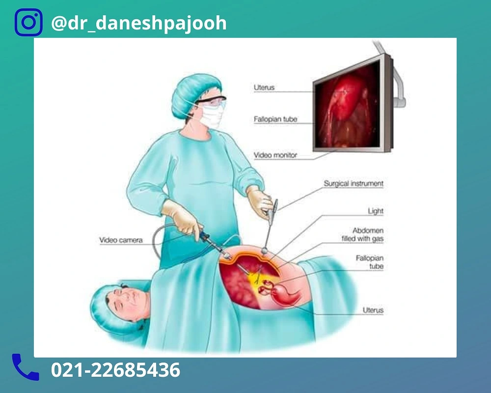 مراقبت بعد از لاپاراسکوپی