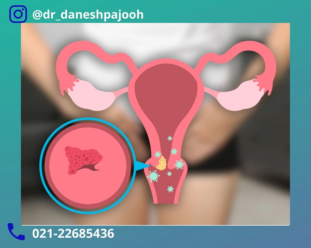 زگیل تناسلی در زنان چیست