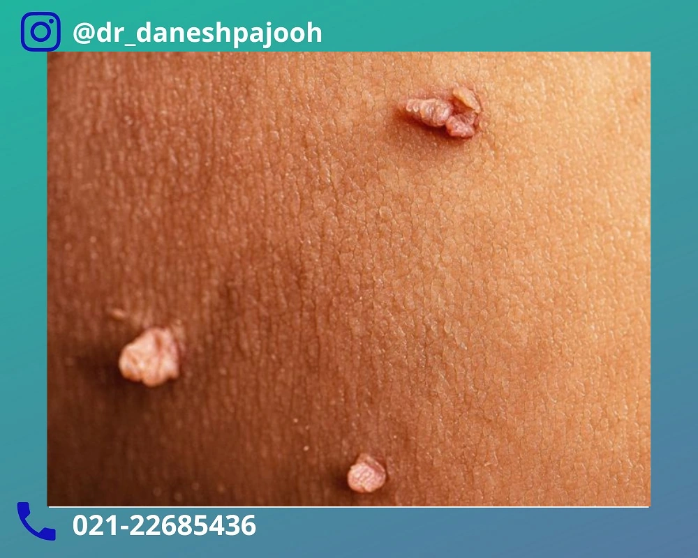 تفاوت های درمان زگیل تناسلی در زنان