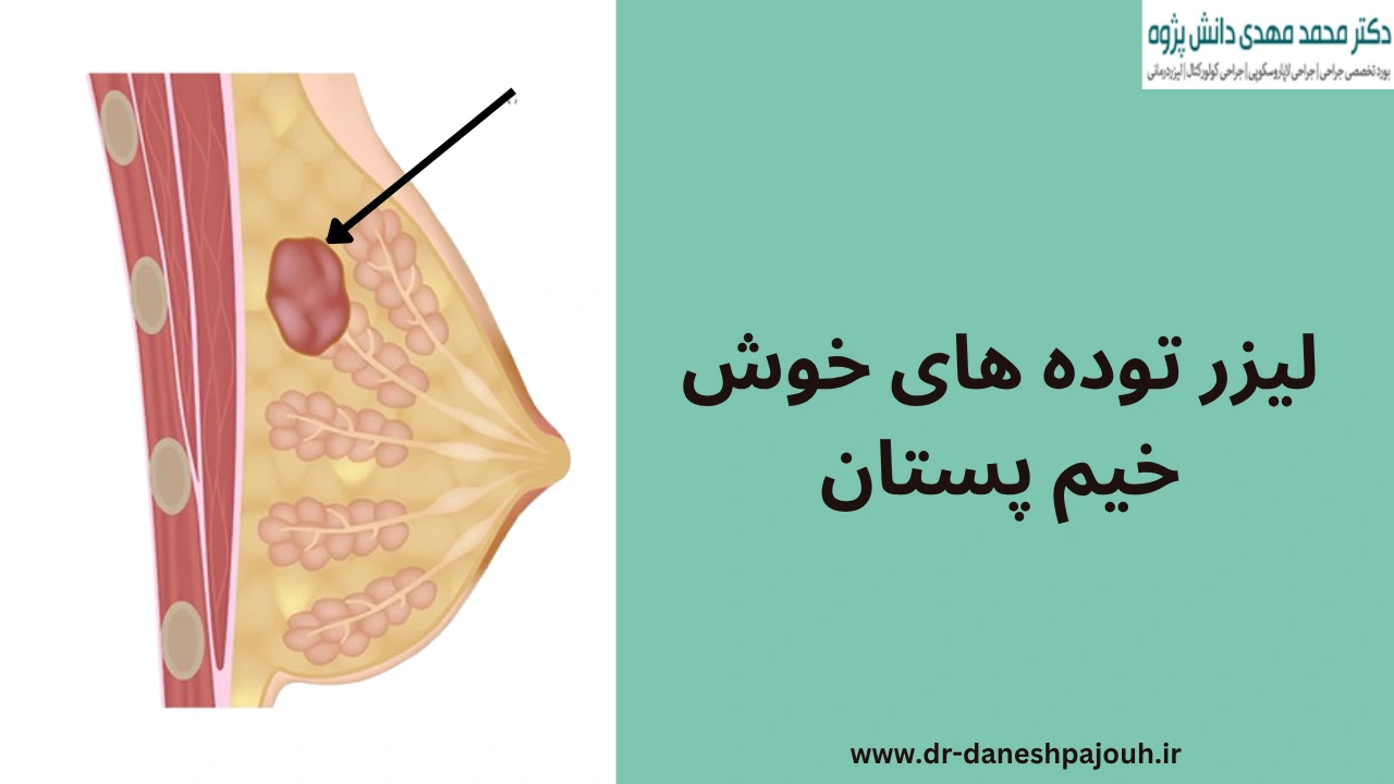 لیزر توده های خوش خیم پستان