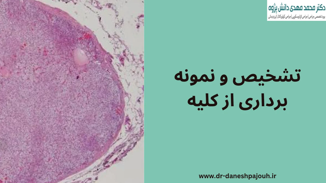 تشخیص و نمونه برداری از غدد کلیه