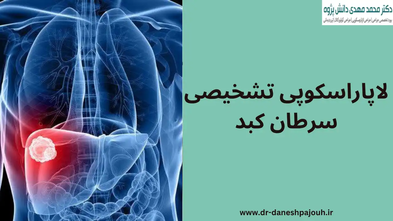 لاپاراسکوپی تشخیصی سرطان کبد چیست؟