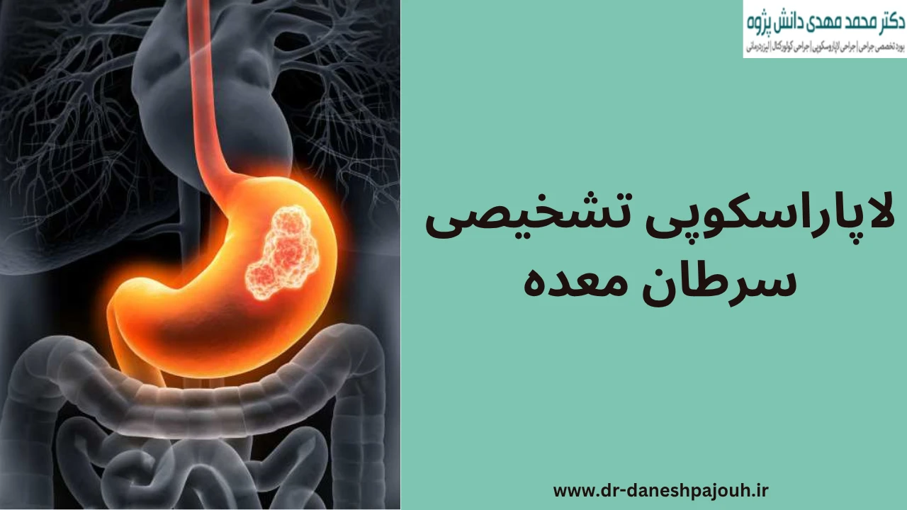 لاپاراسکوپی تشخیصی سرطان معده چیست؟