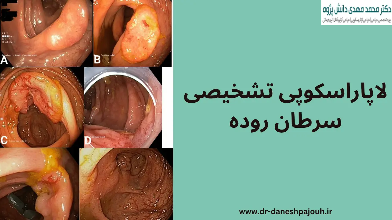 لاپاراسکوپی تشخیصی سرطان روده چیست؟