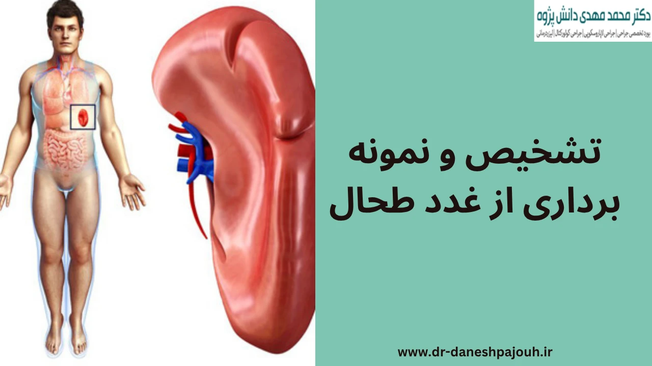 تشخیص و نمونه برداری از غدد طحال