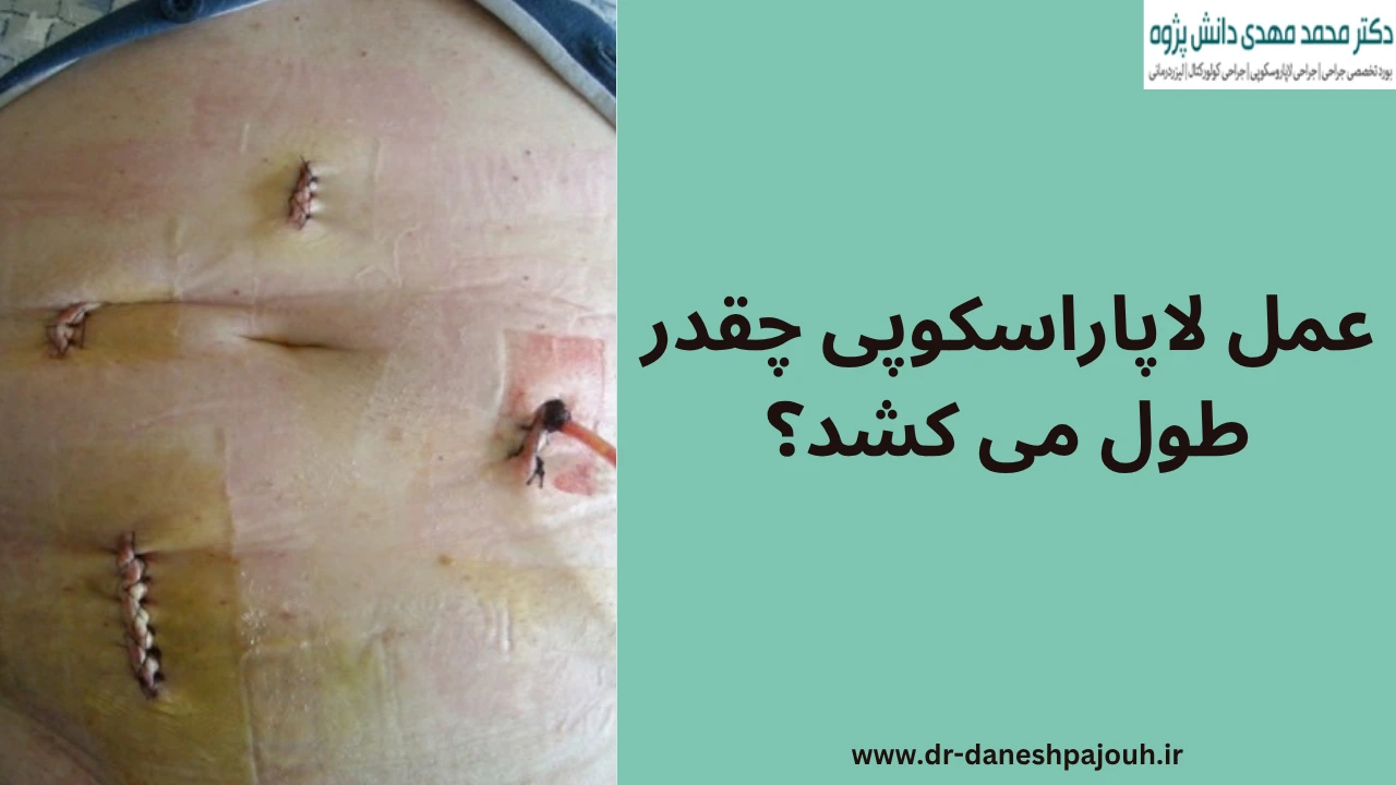 عمل لاپاراسکوپی چقدر طول می کشد؟