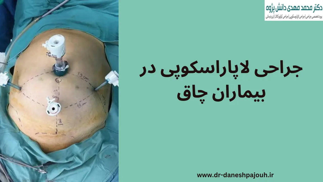 جراحی لاپاراسکوپی در بیماران چاق