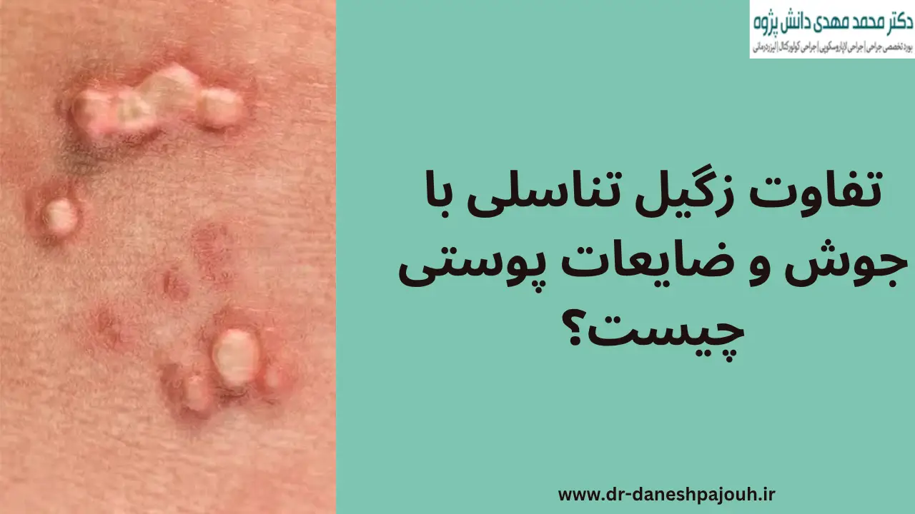 تفاوت زگیل تناسلی با جوش و ضایعات پوستی چیست؟