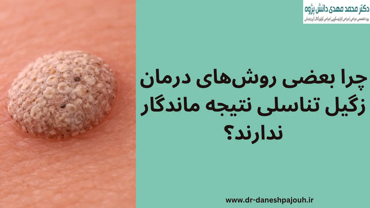 چرا بعضی روشهای درمان زگیل تناسلی نتیجه ماندگار ندارند؟